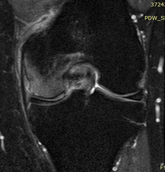 Knee: bone marrow edema